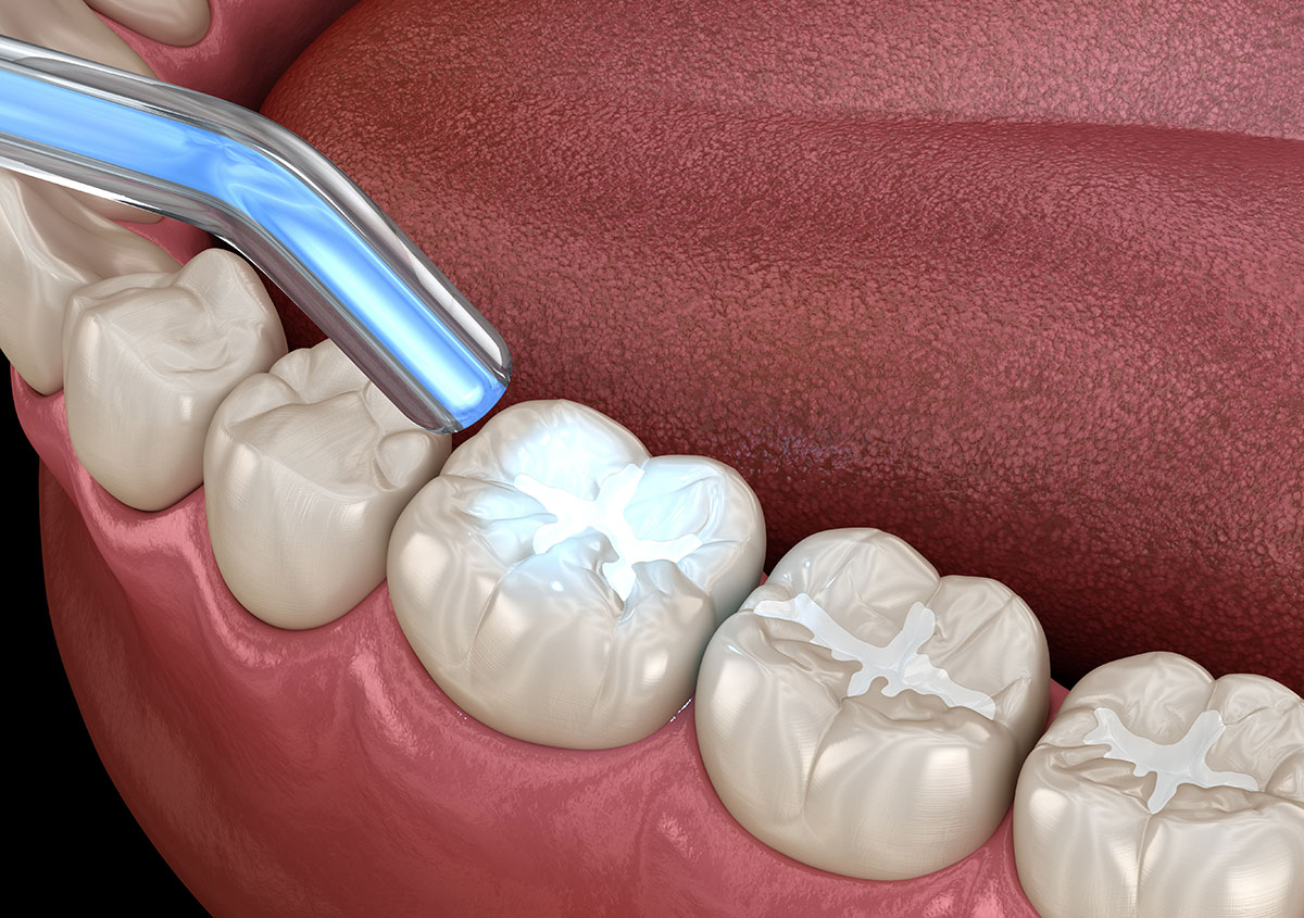 composite-fillings composite-fillings