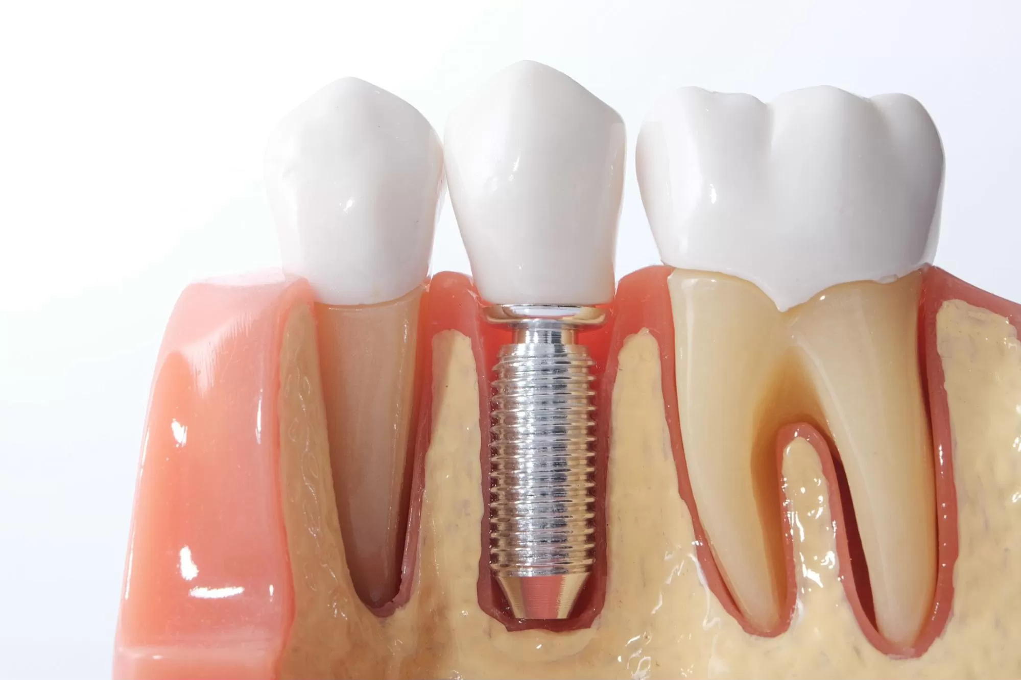 dental-implant-Model dental-implant-Model