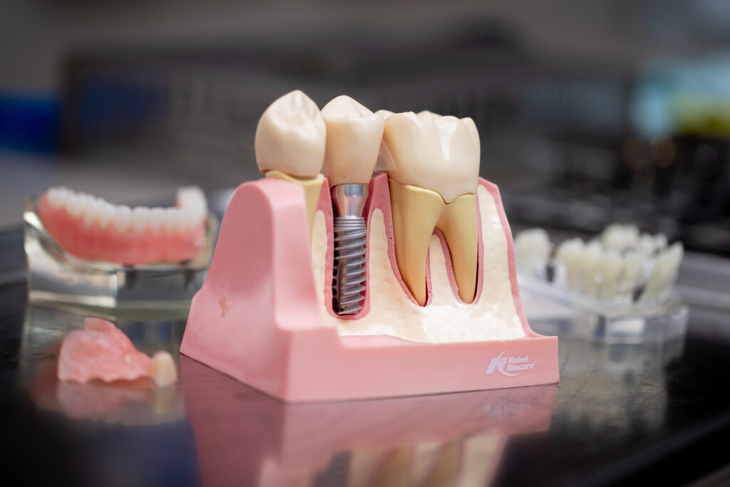 Dental_Implants Dental_Implants