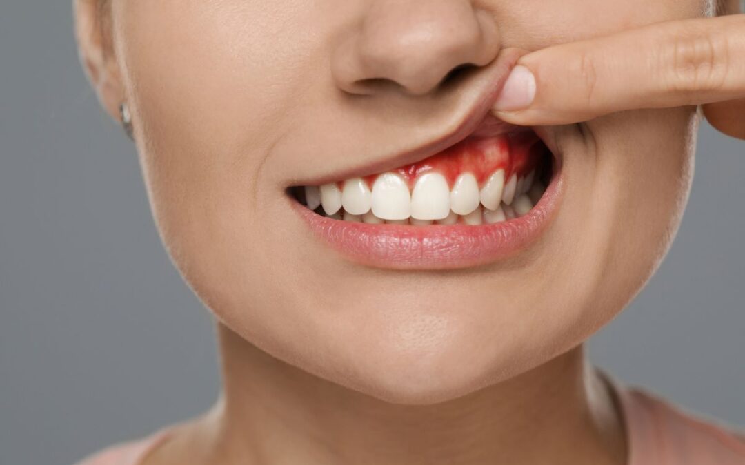 Gum-Contouring Gum-Contouring