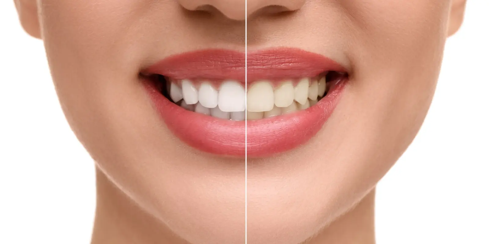 Tooth Whitening Tooth Whitening